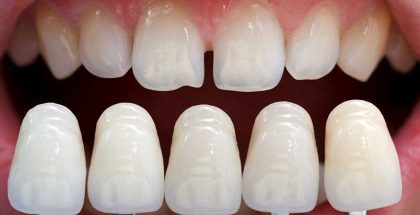Faccette dentali: tutto quello che bisogna sapere