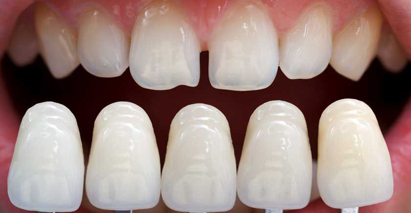 Faccette dentali- tutto quello che bisogna sapere