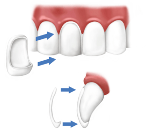 faccette-dentali