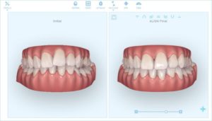 Denti storti e nuove soluzioni per raddrizzarli