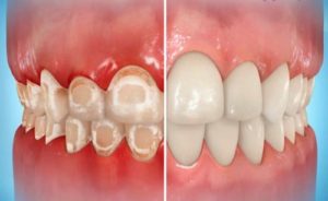 trattamento-macchie-bianche-denti-faccette-dentali-e1547118429336-300x184