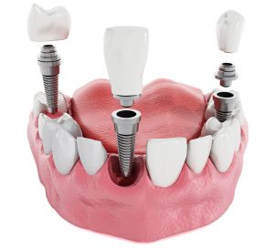 impianto-dentale