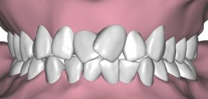 Affollamento dei denti