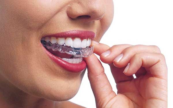 Applicazione degli aligner Invisalign 