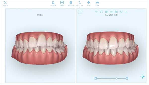 Invisalign ClinCheck 