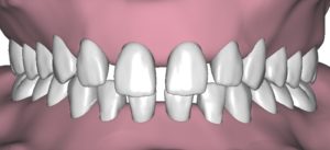 Distanziamento dei denti