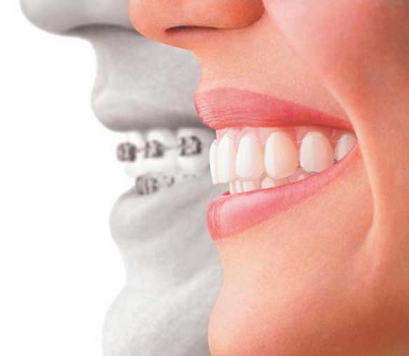 Invisalign  Niente fili metallici 