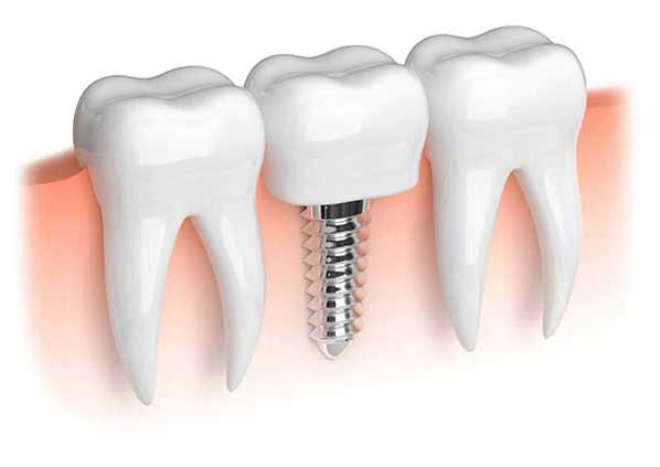 Esempio di un impianto dentale effettuato a Napoli