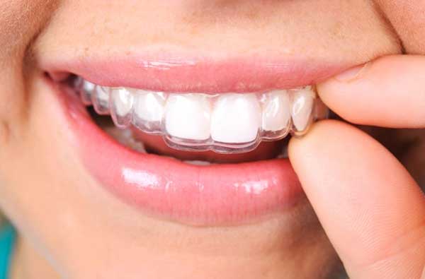 Sostituzione degli aligner Invisalign