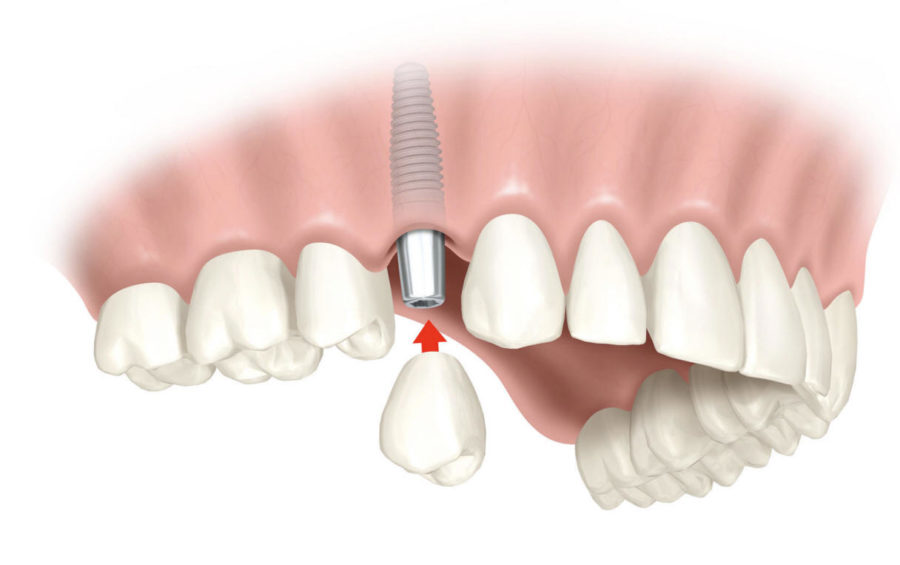 Capsula dentale: che fare se si stacca, quanto costa incapsulare un dente?