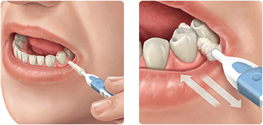 Scovolino dentale: come usarlo e quale scegliere - Studio