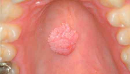 papilloma a cellule squamose lingua