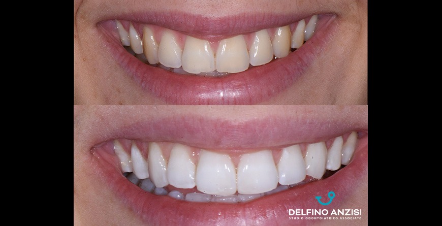 Caso clinico: ricostruzione estetiche in resina composita - Studio  Dentistico Delfino Anzisi