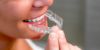 Ortodonzia: come allineare e riposizionare i denti